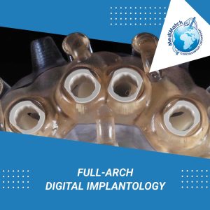 Full-arch digital implantology